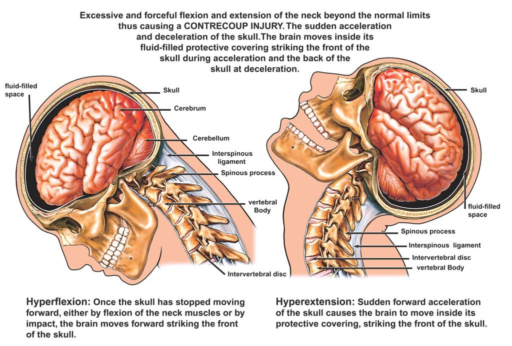 Railroad Brain injury traumatic attorneys_serious_catastrophic