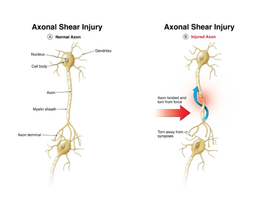 Railroad Spinal Injury