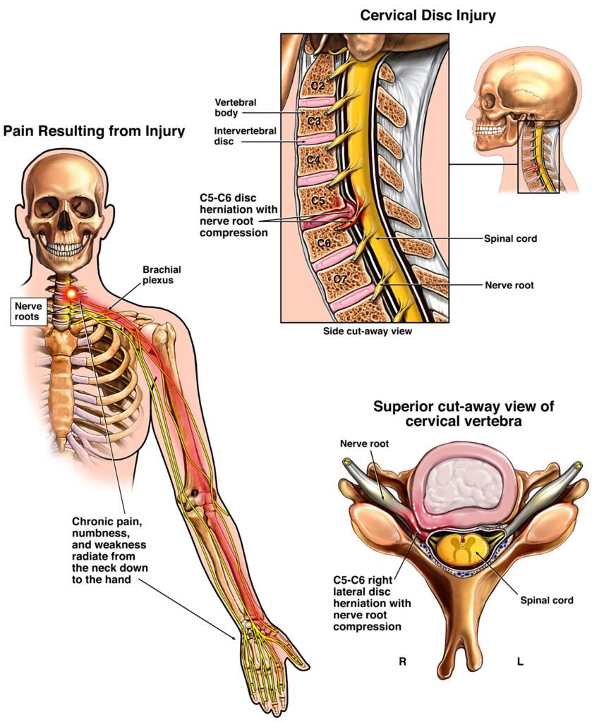 Railroad spinal neck injury